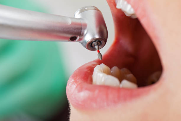 Best Emergency Tooth Extraction in East Dublin, GA